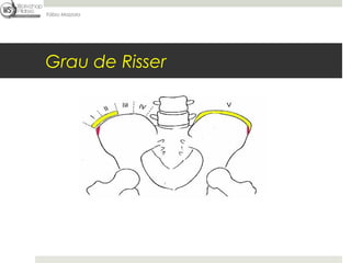 Fábio Mazzola




Grau de Risser
 