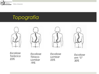 Fábio Mazzola




  Topografia




Escoliose         Escoliose   Escoliose   Escoliose
Torácica          Tóraco-     Lombar      em “S”
25%               Lombar      25%         30%
                  19%
 