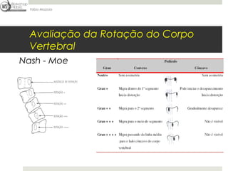 Fábio Mazzola




  Avaliação da Rotação do Corpo
  Vertebral
Nash - Moe
 
