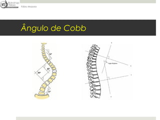 Fábio Mazzola




Ângulo de Cobb
 