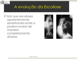A evolução da Escoliose

É fato que escolioses
   aparentemente
   semelhantes entre si
   podem evoluir de
   maneira
   completamente
   diversa.




                  Fábio Mazzola
 