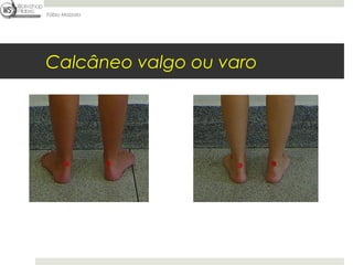 Fábio Mazzola




Calcâneo valgo ou varo
 