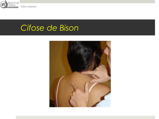 Fábio Mazzola




Cifose de Bison
 