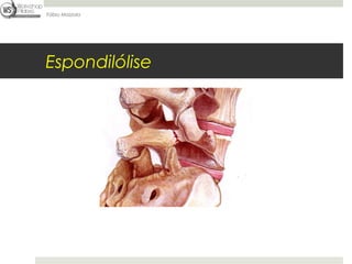 Fábio Mazzola




Espondilólise
 