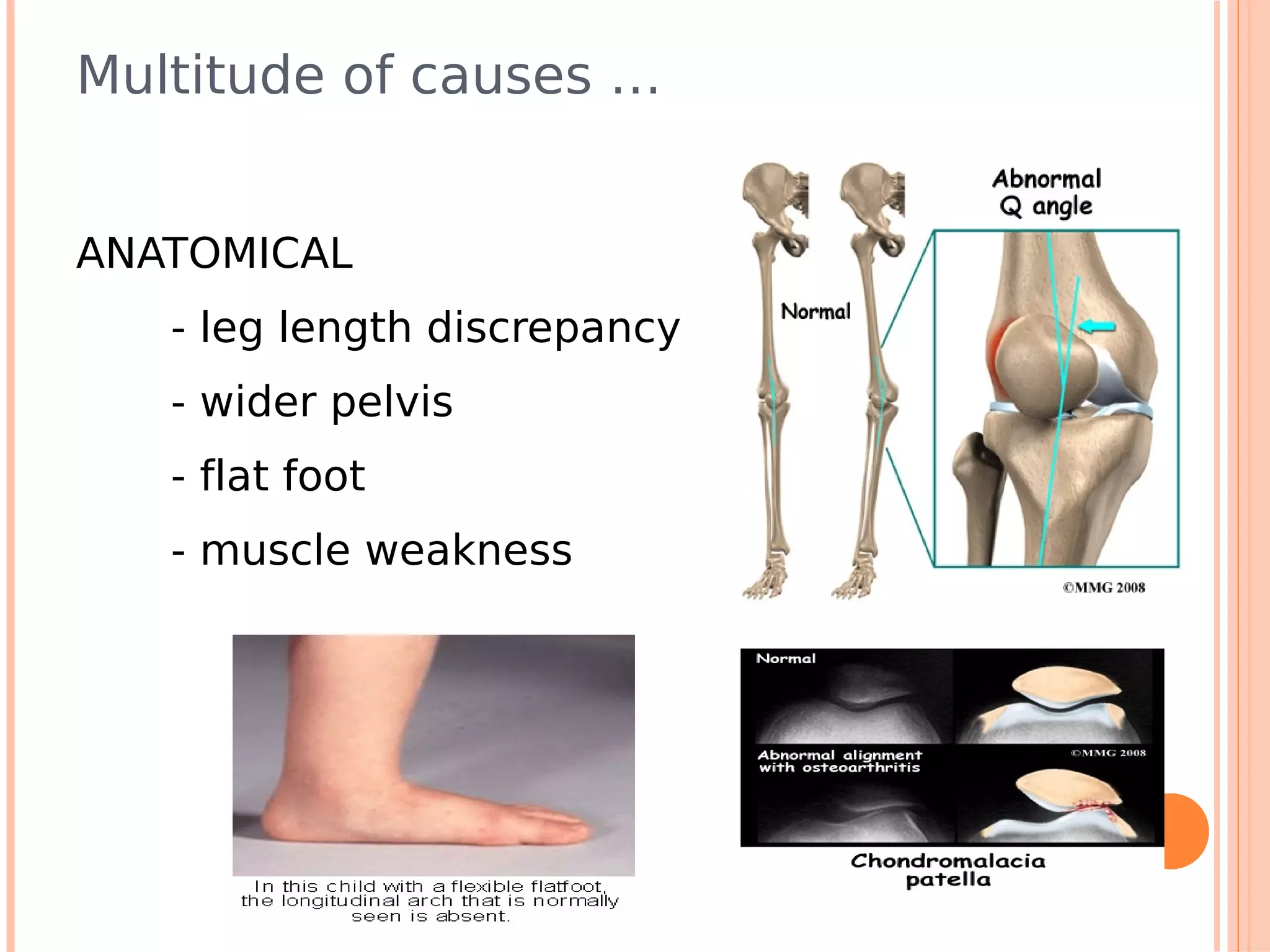 Multitude of causes …


ANATOMICAL
   - leg length discrepancy
   - wider pelvis
   - flat foot
   - muscle weakness
 