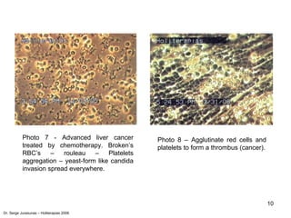 10
Photo 7 - Advanced liver cancer
treated by chemotherapy. Broken’s
RBC’s – rouleau – Platelets
aggregation – yeast-form like candida
invasion spread everywhere.
Photo 8 – Agglutinate red cells and
platelets to form a thrombus (cancer).
Dr. Serge Jurasunas – Holiterapias 2006
 