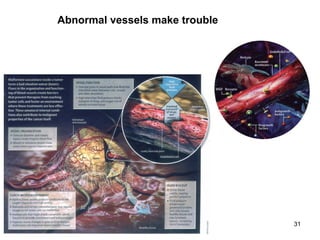 31
Abnormal vessels make trouble
 
