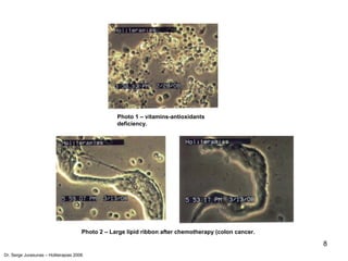 8
Photo 1 – vitamins-antioxidants
deficiency.
Photo 2 – Large lipid ribbon after chemotherapy (colon cancer.
Dr. Serge Jurasunas – Holiterapias 2006
 
