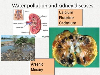 Water pollution and kidney diseases
Calcium
Fluoride
Cadmium
Arsenic
Mecury
 