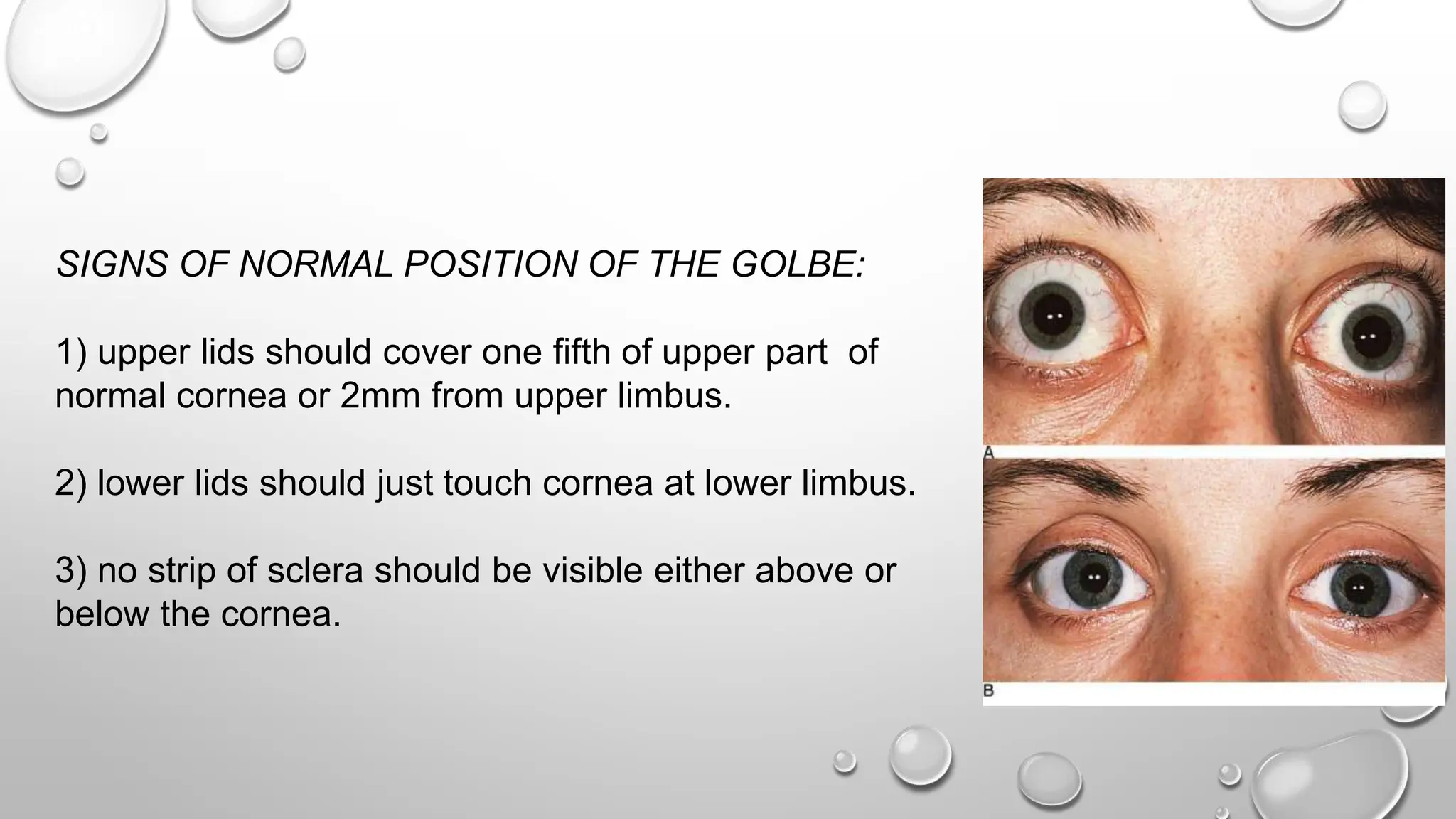 SIGNS OF NORMAL POSITION OF THE GOLBE:
1) upper lids should cover one fifth of upper part of
normal cornea or 2mm from upper limbus.
2) lower lids should just touch cornea at lower limbus.
3) no strip of sclera should be visible either above or
below the cornea.
 