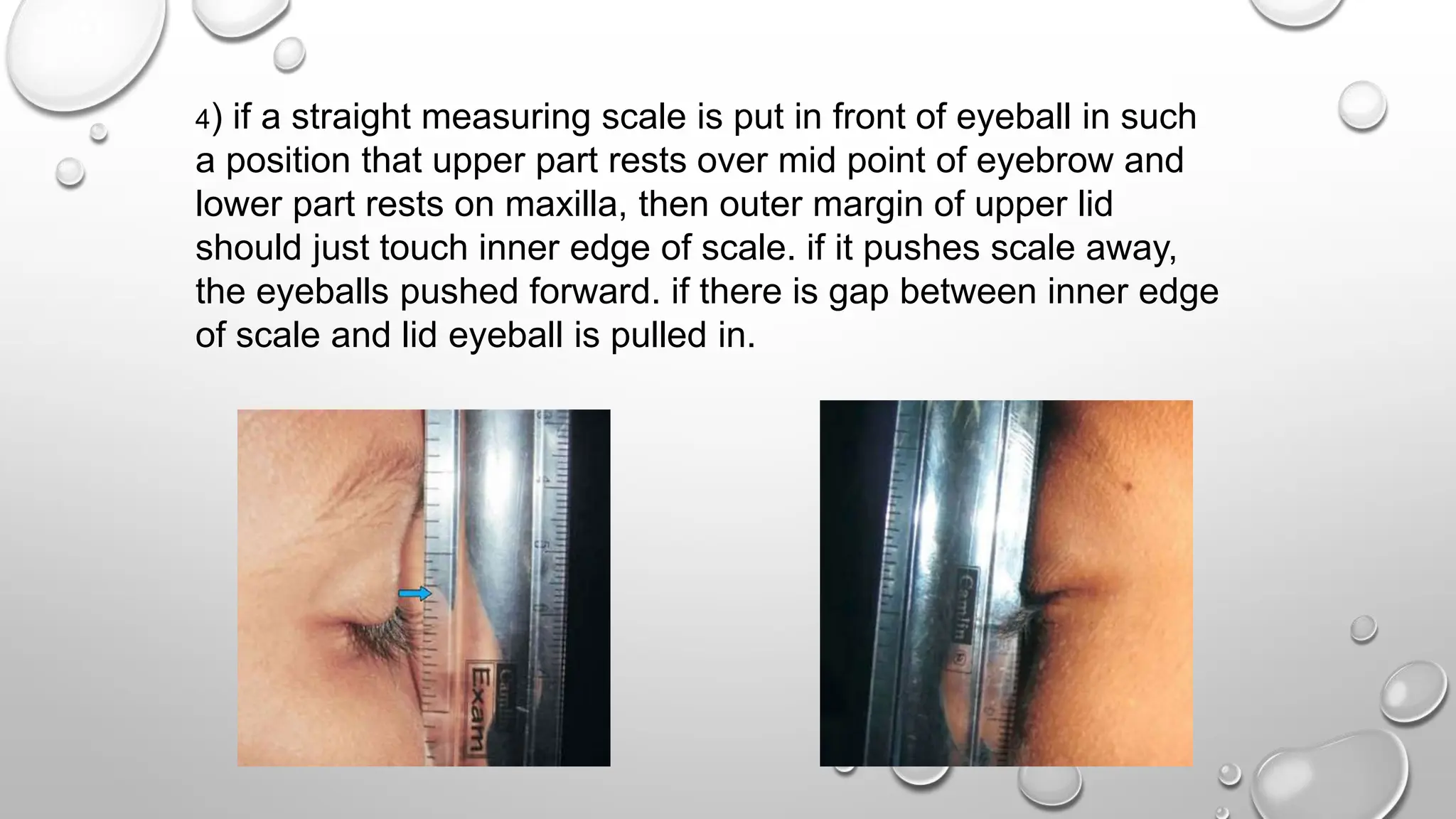 4) if a straight measuring scale is put in front of eyeball in such
a position that upper part rests over mid point of eyebrow and
lower part rests on maxilla, then outer margin of upper lid
should just touch inner edge of scale. if it pushes scale away,
the eyeballs pushed forward. if there is gap between inner edge
of scale and lid eyeball is pulled in.
 