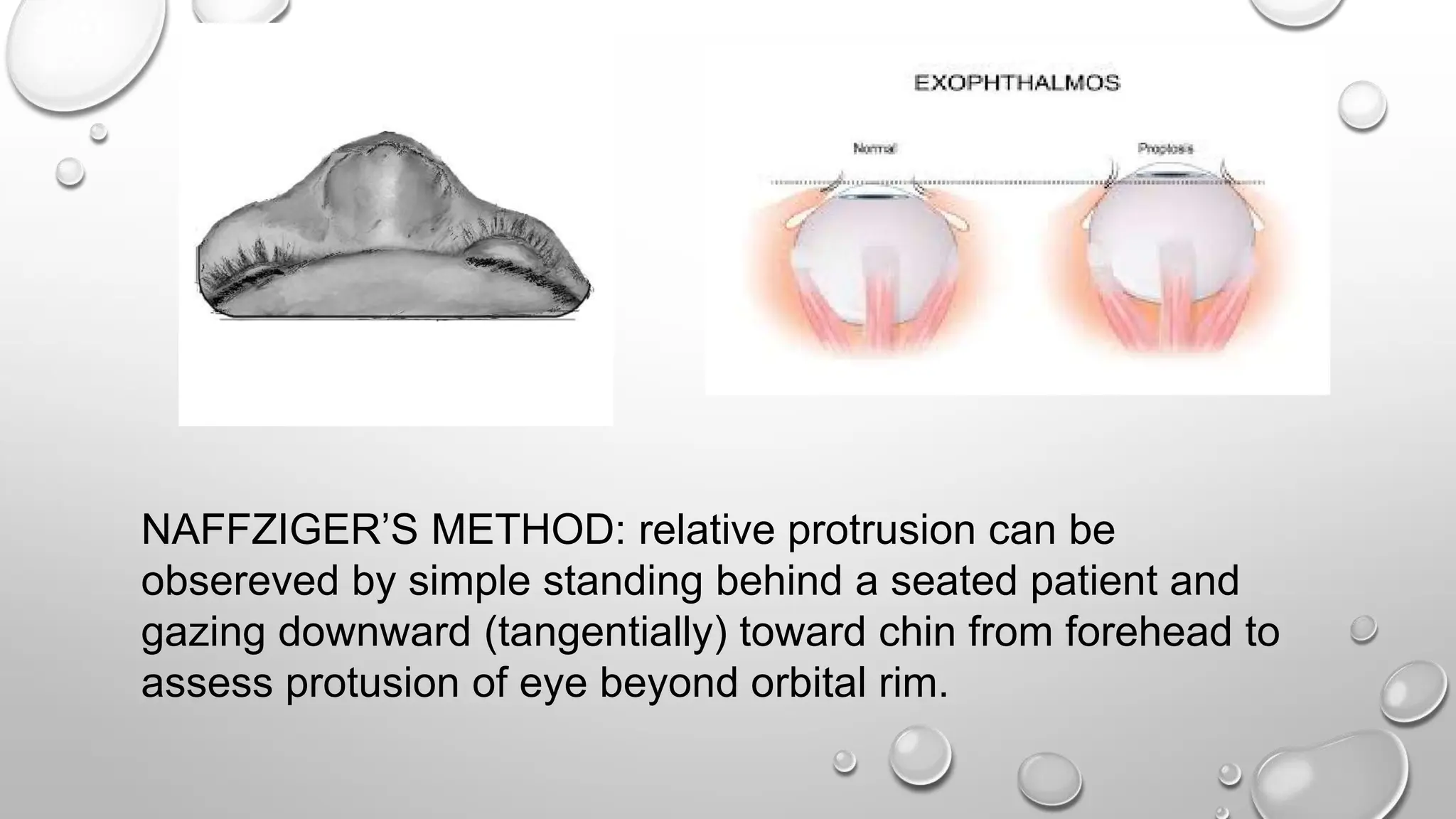 NAFFZIGER’S METHOD: relative protrusion can be
obsereved by simple standing behind a seated patient and
gazing downward (tangentially) toward chin from forehead to
assess protusion of eye beyond orbital rim.
 