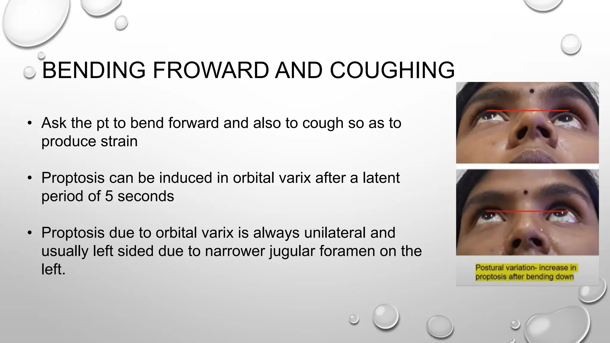 BENDING FROWARD AND COUGHING
• Ask the pt to bend forward and also to cough so as to
produce strain
• Proptosis can be induced in orbital varix after a latent
period of 5 seconds
• Proptosis due to orbital varix is always unilateral and
usually left sided due to narrower jugular foramen on the
left.
 