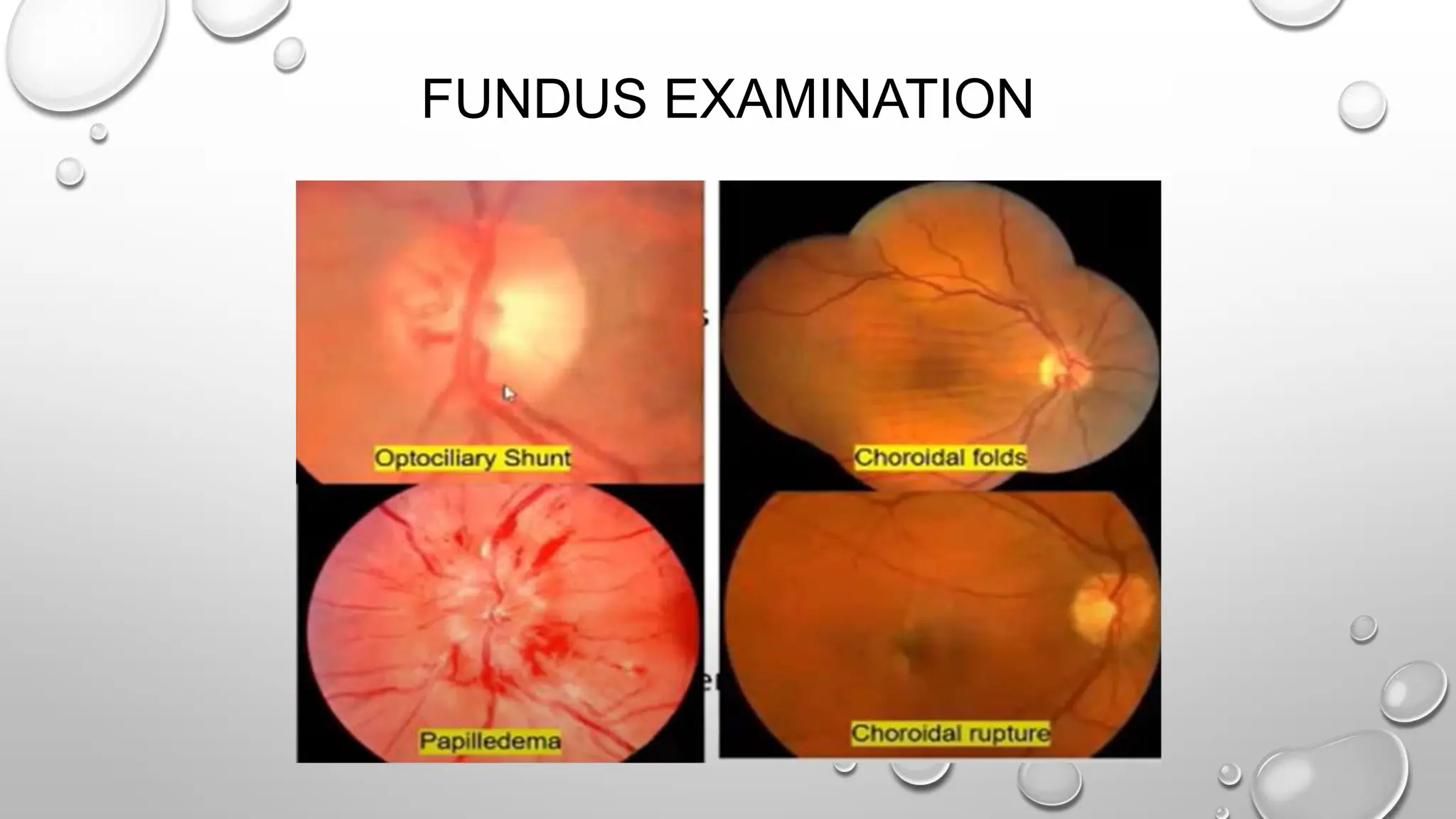 FUNDUS EXAMINATION
 