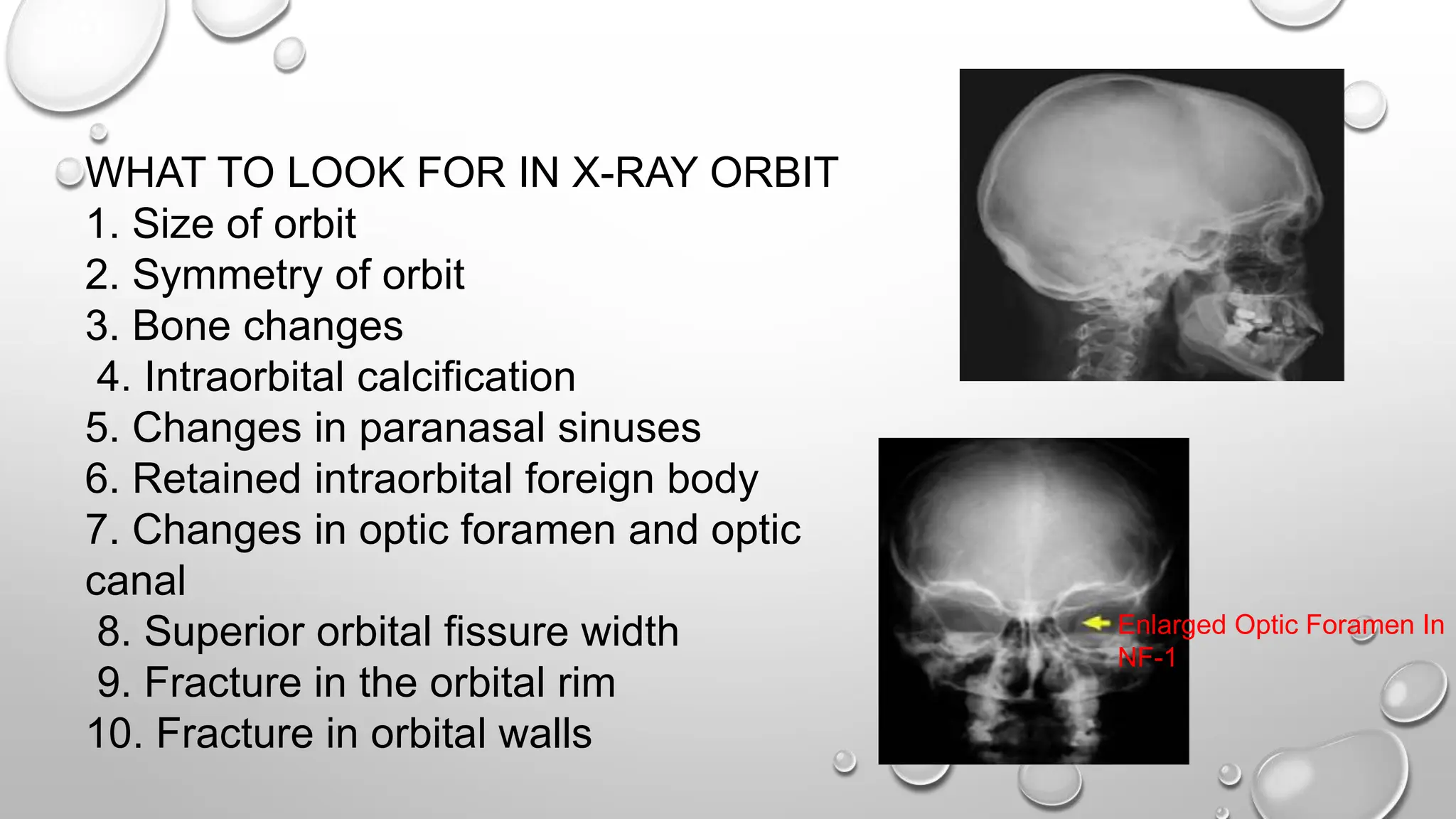 WHAT TO LOOK FOR IN X-RAY ORBIT
1. Size of orbit
2. Symmetry of orbit
3. Bone changes
4. Intraorbital calcification
5. Changes in paranasal sinuses
6. Retained intraorbital foreign body
7. Changes in optic foramen and optic
canal
8. Superior orbital fissure width
9. Fracture in the orbital rim
10. Fracture in orbital walls
Enlarged Optic Foramen In
NF-1
 