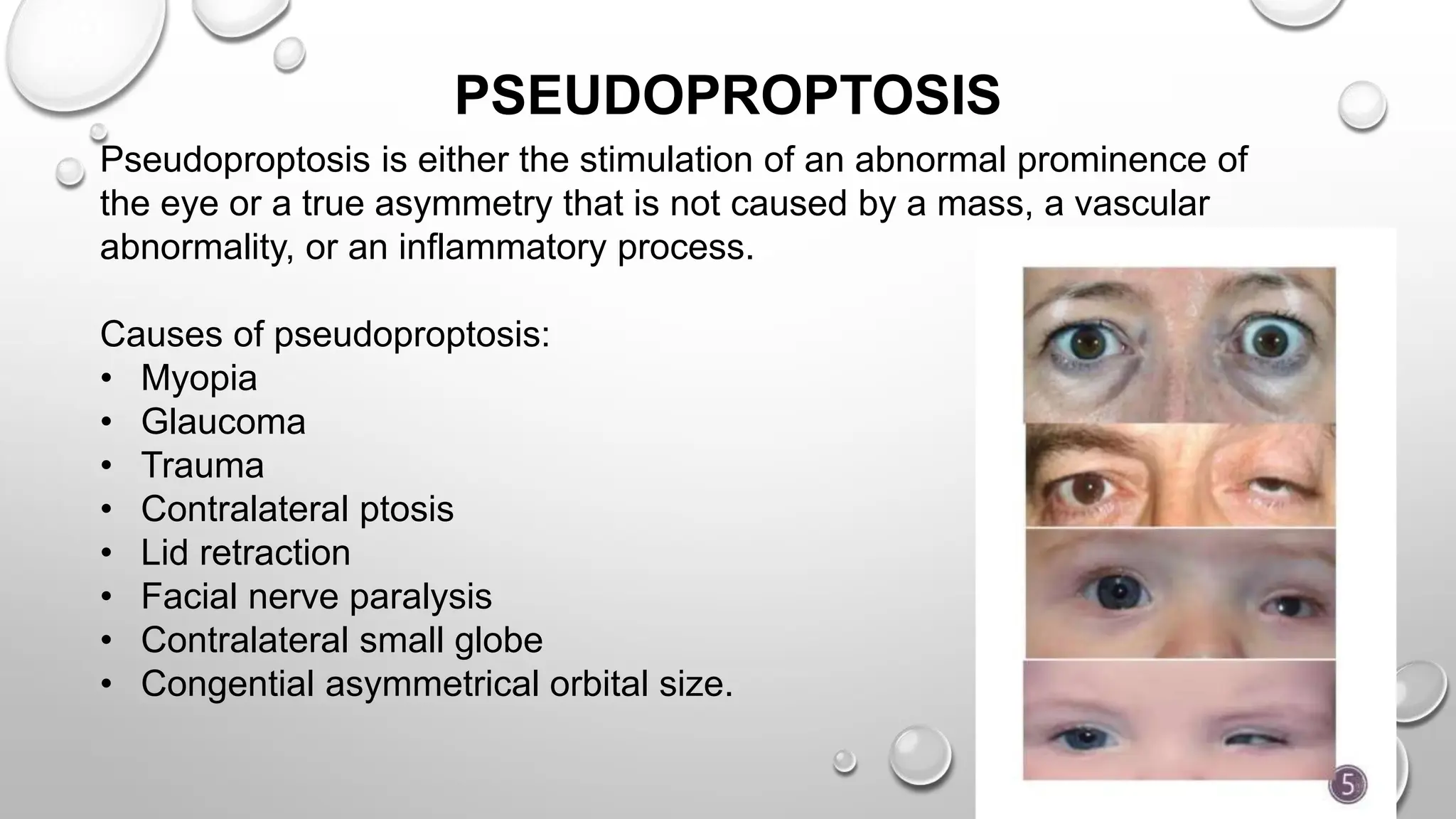 PSEUDOPROPTOSIS
Pseudoproptosis is either the stimulation of an abnormal prominence of
the eye or a true asymmetry that is not caused by a mass, a vascular
abnormality, or an inflammatory process.
Causes of pseudoproptosis:
• Myopia
• Glaucoma
• Trauma
• Contralateral ptosis
• Lid retraction
• Facial nerve paralysis
• Contralateral small globe
• Congential asymmetrical orbital size.
 