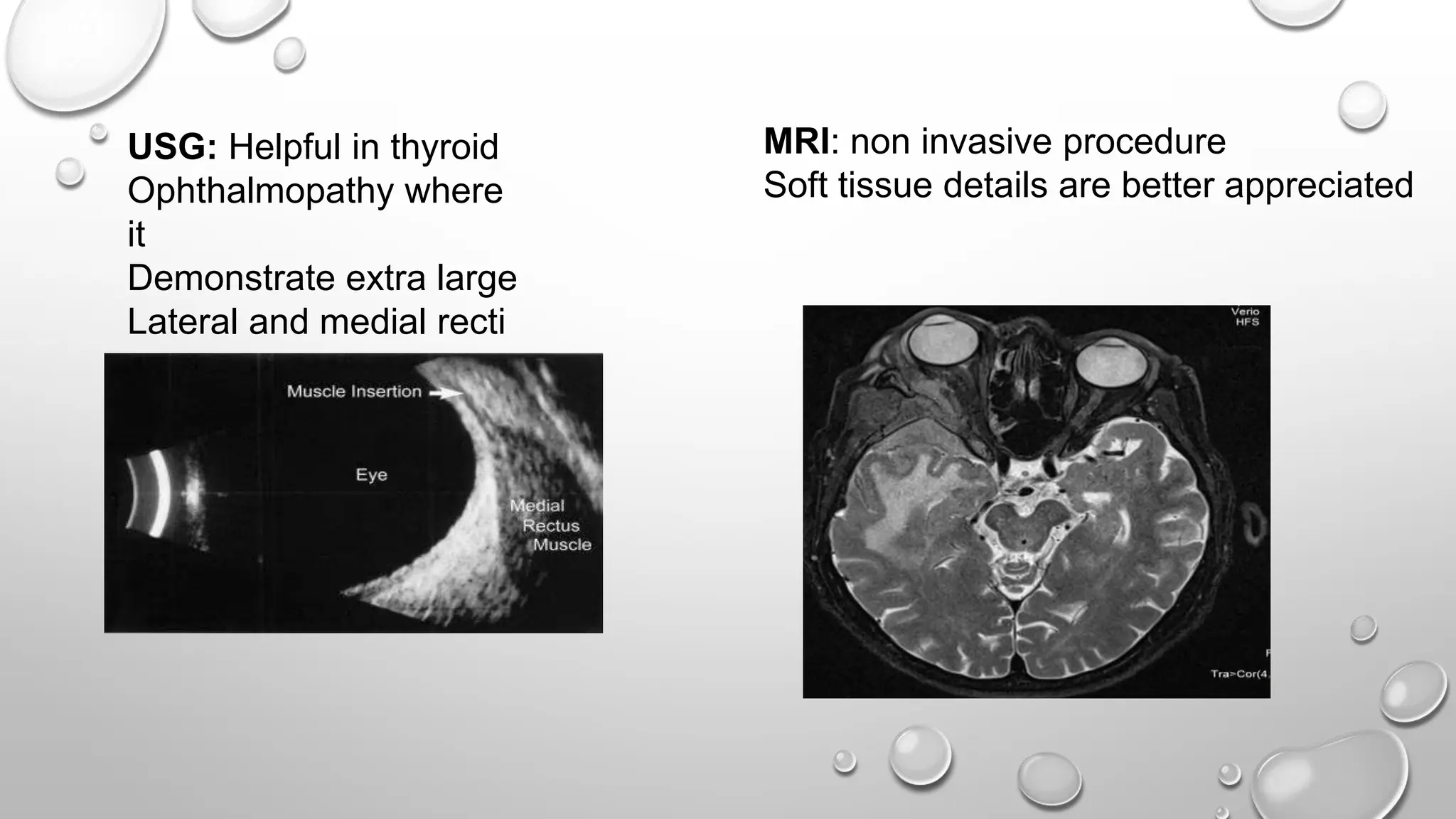 USG: Helpful in thyroid
Ophthalmopathy where
it
Demonstrate extra large
Lateral and medial recti
MRI: non invasive procedure
Soft tissue details are better appreciated
 