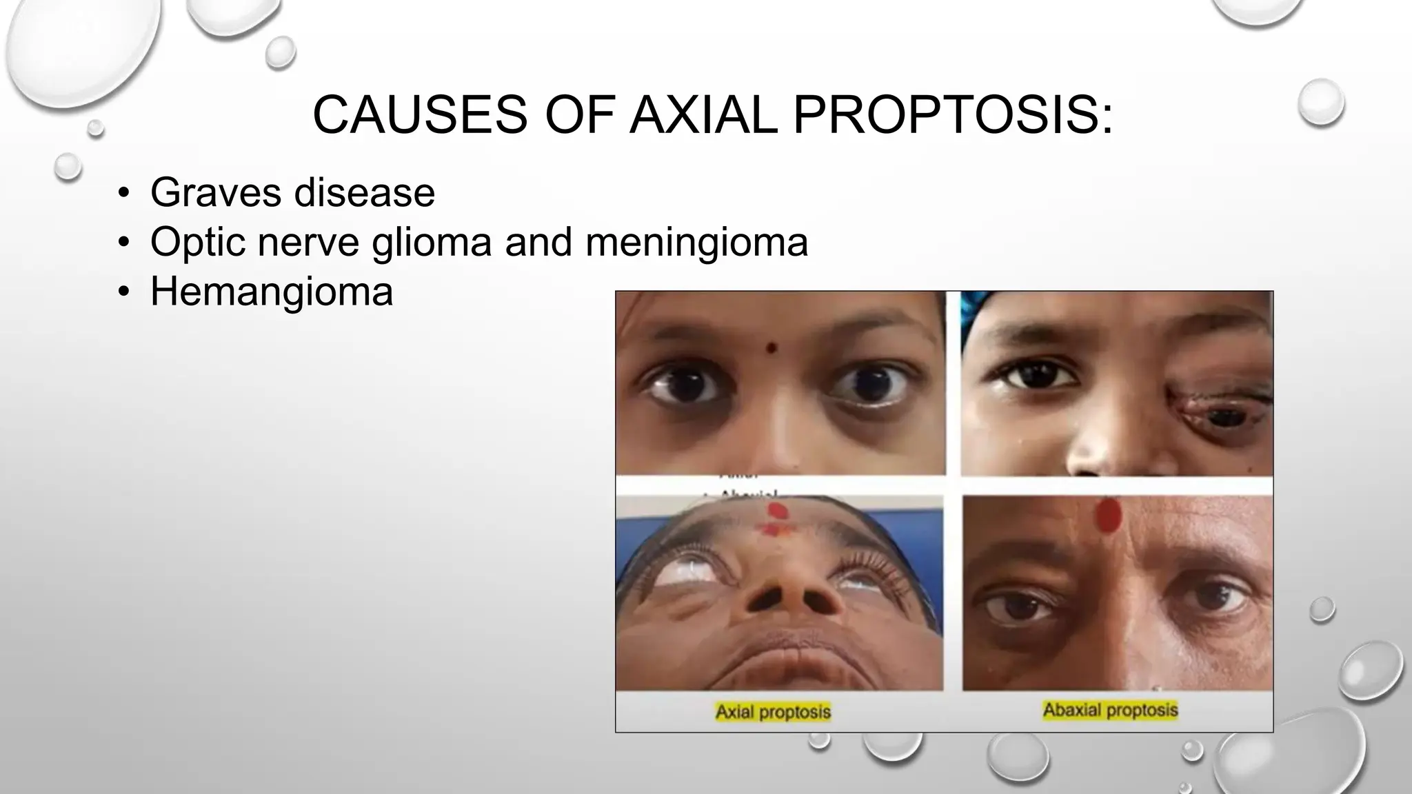 CAUSES OF AXIAL PROPTOSIS:
• Graves disease
• Optic nerve glioma and meningioma
• Hemangioma
 
