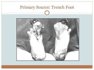 Primary Source: Trench Foot 