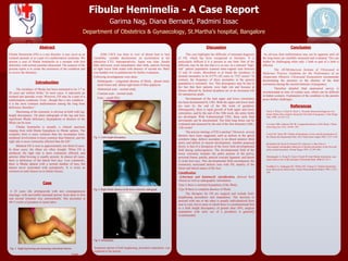 Abstract 
Fibular Hemimelia - A Case Report 
Department of Obstetrics & Gynaecology, St.Martha’s hospital, Bangalore 
Fibular Hemimelia (FH) is a rare disorder; it may occur as an 
isolated anomaly or as a part of a malformation syndrome. We 
present a case of fibular hemimelia in a neonate with foot 
deformity with normal prenatal ultrasound. The purpose of the 
present report is to create the awareness of the condition and 
to review the literature. 
Introduction 
(EM) LSCS was done in view of absent beat to beat 
variability, variable deceleration, no acceleration in the 
admission CTG. Intraoperatively, liquor was clear ,female 
baby delivered, cried immediately after birth, anterior bowing 
of right lower limb noted with absence of second toe. Baby 
was handed over to pediatrician for further evaluation. 
Following investigations were done: 
1) Infantogram – congenital absence of fibula , absent meta-tarsal 
bones and absent right head of tibia epiphysis. 
2) Abdominal scan – normal study 
3) Cranium scan – normal study 
4) Echo – small PDA 
Case 
Discussion Conclusion 
This case highlights the difficulty of antenatal diagnosis 
of FH, which has been recognized in literature. It is 
particularly difficult if it is present in one limb. Part of the 
difficulty may be the fact that it is so rare. In a selected “high-risk” 
patient population scanned trans-vaginal scan between 
12 and 16 weeks, Bronshtein et al found the incidence of 
skeletal anomalies to be 0.57% (42 cases in 7325 scans).4 In 
contrast, the frequency of these anomalies in the general 
population is extremely low. This discrepancy may be due to 
the fact that their patients were high risk and because at 
fetuses affected by skeletal dysplasia are at an increased risk 
for intrauterine death. 
Development of the fetal upper and lower extremities 
has been documented by USG. Both the upper and lower buds 
are seen by the end of the 8th week of gestation. 
Subsequently, there is rapid growth of both upper and lower 
extremities, and by the end of the 10th week, the entire limbs 
are developed. With 4-dimensional USG, these early fetal 
movements can be documented. The fetal long bones can be 
evaluated and measured by the end of the first trimester (10th– 
12th week)5 
The precise etiology of FH is unclear.6 However, several 
theories have been suggested, such as defects in the apical 
ectoderm ridge, defects secondary to an absent anterior tibial 
artery and defects in muscle development. Another proposed 
theory is that of a disruption of the lower limb developmental 
field during embryogenesis. The developmental field of the 
lower extremity includes the pubic portion of the pelvis, 
proximal femur, patella, anterior cruciate ligament, and lateral 
or axial foot rays. This developmental field encompasses the 
commonly associated defects seen with FH, namely of the 
femur and lateral aspect of the foot. 
Classification 
Achterman and Kalamachi classification, derived from 
clinical as well as radiographic information. 
Type I, there is minimal hypoplasia of the fibula, 
Type II-there is complete absence of fibula. 
The therapies for FH are surgical and include limb-lengthening 
procedures and amputation. The decision to 
proceed with one or the other is usually individualized from 
case to case, but in cases in which there is a nonfunctional foot 
or a limb length discrepancy of greater than 30%, surgical 
amputation with early use of a prosthesis is generally 
recommended. 
An obvious fetal malformation may not be apparent until all 
the long bones are carefully measured and evaluated. This can 
further be challenging when only 1 limb or part of a limb is 
affected. 
The AIUM(American Institute of Ultrasound in 
Medicine) Practice Guideline for the Performance of an 
Antepartum Obstetric Ultrasound Examination recommends 
documenting the presence or the absence of the fetal 
extremities during the second trimester of pregnancy. 
Therefore detailed fetal anatomical survey is 
recommended at time of routine scan, which can be difficult 
in Indian scenario. Explanation of the condition to the parents 
poses further challenges. 
References 
1. Florio I, Wisser J, Huch R, Huch A. Prenatal ultrasound diagnosis of a 
femur-fibula-ulna complex during the first half of pregnancy. Fetal Diagn 
Ther 1999; 14:310–312. 
2. Coventry MB, Johnson EW JR. Congenital absence of the fibula. J Bone 
Joint Surg Am 1952; 34:941–955. 
3. Lewin SO, Opitz JM. Fibular a/hypoplasia: review and documentation of 
the fibular developmental field. Am J Med Genet Suppl 1986; 2:215–238 
4. Bronshtein M, Keret D, Deutsch M, Liberson A, Bar Chava I. 
Transvaginal sonographic detection of skeletal anomalies in the first and 
early second trimesters. Prenat Diagn 1993; 13:597–601. 
5. Monteagudo A, Dong R, Timor-Tritsch IE.Fetal fibular hemimelia: case 
report and review of the literature Ultrasound Med. 2006;25:533-7. 
6. Fordham LA, Applegate KE, Wilkes DC, Chung CJ. Fibular hemimelia: 
more than just an absent bone. Semin Musculoskelet Radiol 1999; 3:227– 
238. 
The incidence of fibular has been estimated to be 5.7 to 
20 cases per million births.1 In most cases, it represents an 
isolated and sporadic event. However, FH may be a part of a 
malformation syndrome. Even , though this a rare condition , 
it is the most common malformation among the long bone 
deficiency disorders.2 
Shortening of the extremity is obvious at birth with leg-length 
discrepancy. On plain radiograph of the leg and foot, 
significant fibular deficiency (hypoplasia) or absence of the 
fibula can be seen. 
Fibular hemimelia is actually a clinical spectrum 
ranging from mild fibular hypoplasia to fibular aplasia. The 
complete form is more common than the incomplete form; 
unilateral involvement is more common than bilateral; and the 
right side is more commonly affected than the left.3 
Bilateral FH is seen in approximately one third of cases. 
In these cases, the tibiae are often straight. When FH is 
unilateral, the right side is more commonly affected, and 
anterior tibial bowing is usually present. In almost all cases, 
there is deficiency of the lateral foot rays. Less commonly, 
there is fibular aplasia with a normal number of toes, but 
almost never associated with polydactyly. It is twice as 
common in male fetuses as in female fetuses. 
Fig. 2: Limb length discrepancy 
A 23 years old, primigravida with non consanguineous 
marriage, with uneventful antenatal period. Scan done in first 
and second trimester was unremarkable. She presented at 
40+5 weeks of gestation in latent labor. 
Garima Nag, Diana Bernard, Padmini Issac 
Fig. 1: Right leg bowing and shortening with absent 2nd toe. 
Fig. 3: Right fibular absence in the lower extremity radiograph 
Fig. 4: Infantogram 
Treatment options of limb lengthening procedure/ amputation was 
explained to the parents. 
Contd…. 
