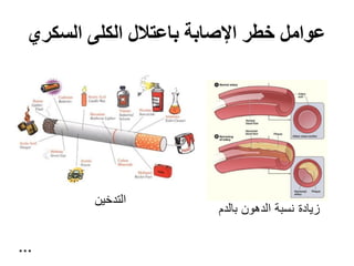 ‫السكري‬ ‫الكلى‬ ‫باعتالل‬ ‫اإلصابة‬ ‫خطر‬ ‫عوامل‬
‫بالدم‬ ‫الدهون‬ ‫نسبة‬ ‫زيادة‬
‫التدخين‬
…
 