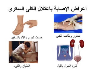 ‫السكري‬ ‫الكلى‬ ‫باعتالل‬ ‫اإلصابة‬ ‫أعراض‬
‫بالساقين‬ ‫أواآلم‬ ‫تورم‬ ‫حدوث‬ ‫الكلى‬ ‫وظائف‬ ‫تدهور‬
‫بالليل‬ ‫التبول‬ ‫كثرة‬‫والقيء‬ ‫الغثيان‬
 