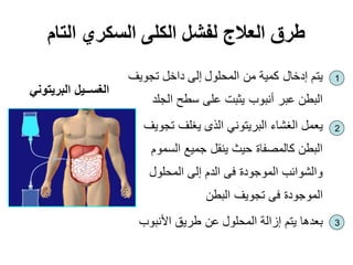 ‫التام‬ ‫السكري‬ ‫الكلى‬ ‫لفشل‬ ‫العالج‬ ‫طرق‬
‫تجويف‬ ‫داخل‬ ‫إلى‬ ‫المحلول‬ ‫من‬ ‫كمية‬ ‫إدخال‬ ‫يتم‬
‫الجلد‬ ‫سطح‬ ‫على‬ ‫يثبت‬ ‫أنبوب‬ ‫عبر‬ ‫البطن‬
‫تجويف‬ ‫يغلف‬ ‫الذى‬ ‫البريتوني‬ ‫الغشاء‬ ‫يعمل‬
‫السموم‬ ‫جميع‬ ‫ينقل‬ ‫حيث‬ ‫كالمصفاة‬ ‫البطن‬
‫المحلول‬ ‫إلى‬ ‫الدم‬ ‫فى‬ ‫الموجودة‬ ‫والشوائب‬
‫البطن‬ ‫تجويف‬ ‫فى‬ ‫الموجودة‬
‫األنبوب‬ ‫طريق‬ ‫عن‬ ‫المحلول‬ ‫إزالة‬ ‫يتم‬ ‫بعدها‬
‫البريتوني‬ ‫الغســيل‬
1
2
3
 