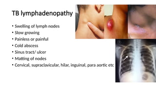 TB lymphadenopathy
• Swelling of lymph nodes
• Slow growing
• Painless or painful
• Cold abscess
• Sinus tract/ ulcer
• Matting of nodes
• Cervical, supraclavicular, hilar, inguinal, para aortic etc
 