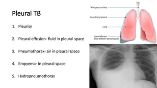 Pleural TB
1. Pleurisy
2. Pleural effusion- fluid in pleural space
3. Pneumothorax- air in pleural space
4. Empyema- in pleural space
5. Hydropneumothorax
 