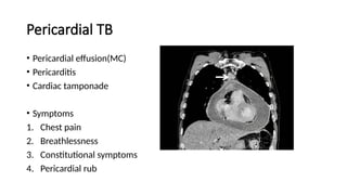 Pericardial TB
• Pericardial effusion(MC)
• Pericarditis
• Cardiac tamponade
• Symptoms
1. Chest pain
2. Breathlessness
3. Constitutional symptoms
4. Pericardial rub
 