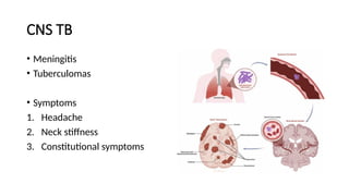 CNS TB
• Meningitis
• Tuberculomas
• Symptoms
1. Headache
2. Neck stiffness
3. Constitutional symptoms
 