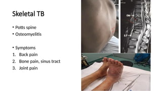 Skeletal TB
• Potts spine
• Osteomyelitis
• Symptoms
1. Back pain
2. Bone pain, sinus tract
3. Joint pain
 
