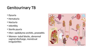 Genitourinary TB
• Dysuria
• Hematuria
• Nocturia
• Infertility
• Sterile pyuria
• Men- epididymo orchitis, prostatitis
• Women- tubal blocks, abnormal
vaginal discharge, menstrual
irregularities
 