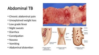 Abdominal TB
• Chronic abdominal pain
• Unexplained weight loss
• Low grade fever
• Night sweats
• Diarrhea
• Constipation
• Nausea
• Vomiting
• Abdominal distention
 
