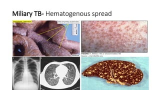 Miliary TB- Hematogenous spread
 