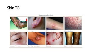 Skin TB
 