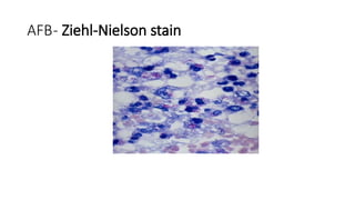 AFB- Ziehl-Nielson stain
 
