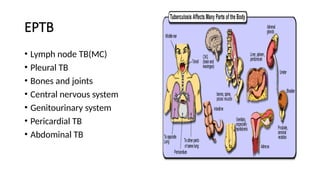 EPTB
• Lymph node TB(MC)
• Pleural TB
• Bones and joints
• Central nervous system
• Genitourinary system
• Pericardial TB
• Abdominal TB
 