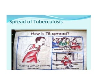 The risk of developing active TB
is higher in:
• anyone with a weakened immune system
• anyone who first developed the inf...