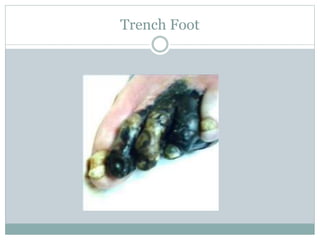 Trench Foot
 