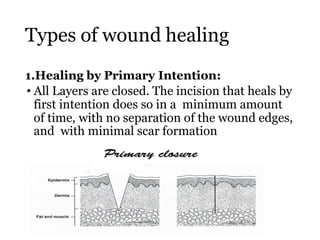 Types of wound healing
1.Healing by Primary Intention:
• All Layers are closed. The incision that heals by
first intention does so in a minimum amount
of time, with no separation of the wound edges,
and with minimal scar formation
 
