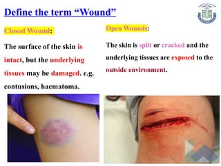 Define the term “Wound”
Closed Wound:
The surface of the skin is
intact, but the underlying
tissues may be damaged. e.g.
contusions, haematoma.
Open Wounds:
The skin is split or cracked and the
underlying tissues are exposed to the
outside environment.
 