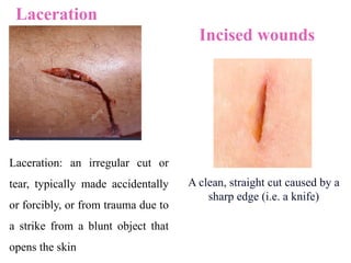 Incised wounds
A clean, straight cut caused by a
sharp edge (i.e. a knife)
Laceration
Laceration: an irregular cut or
tear, typically made accidentally
or forcibly, or from trauma due to
a strike from a blunt object that
opens the skin
 