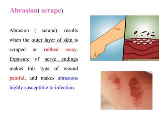 Abrasion( scrape)
Abrasion ( scrape): results
when the outer layer of skin is
scraped or rubbed away.
Exposure of nerve endings
makes this type of wound
painful, and makes abrasions
highly susceptible to infection.
 