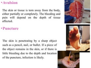 •Avulsion
•Puncture
The skin is penetrating by a sharp object
such as a pencil, nail, or bullet. If a piece of
the object remains in the skin, or if there is
little bleeding due to the depth and location
of the puncture, infection is likely.
The skin or tissue is torn away from the body,
either partially or completely. The bleeding and
pain will depend on the depth of tissue
affected.
 
