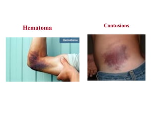 Contusions
Hematoma
 