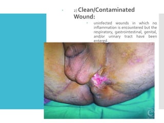  2) Clean/Contaminated
Wound:
 uninfected wounds in which no
inflammation is encountered but the
respiratory, gastrointestinal, genital,
and/or urinary tract have been
entered.
 