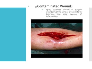  3) Contaminated Wound:
 open, traumatic wounds or surgical
wounds involving a major break in sterile
technique that show evidence of
inflammation.
 