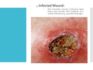  4) Infected Wound:
 old, traumatic wounds containing dead
tissue and wounds with evidence of a
clinical infection (e.g., purulent drainage).
 