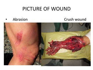 PICTURE OF WOUND
• Abrasion Crush wound
 